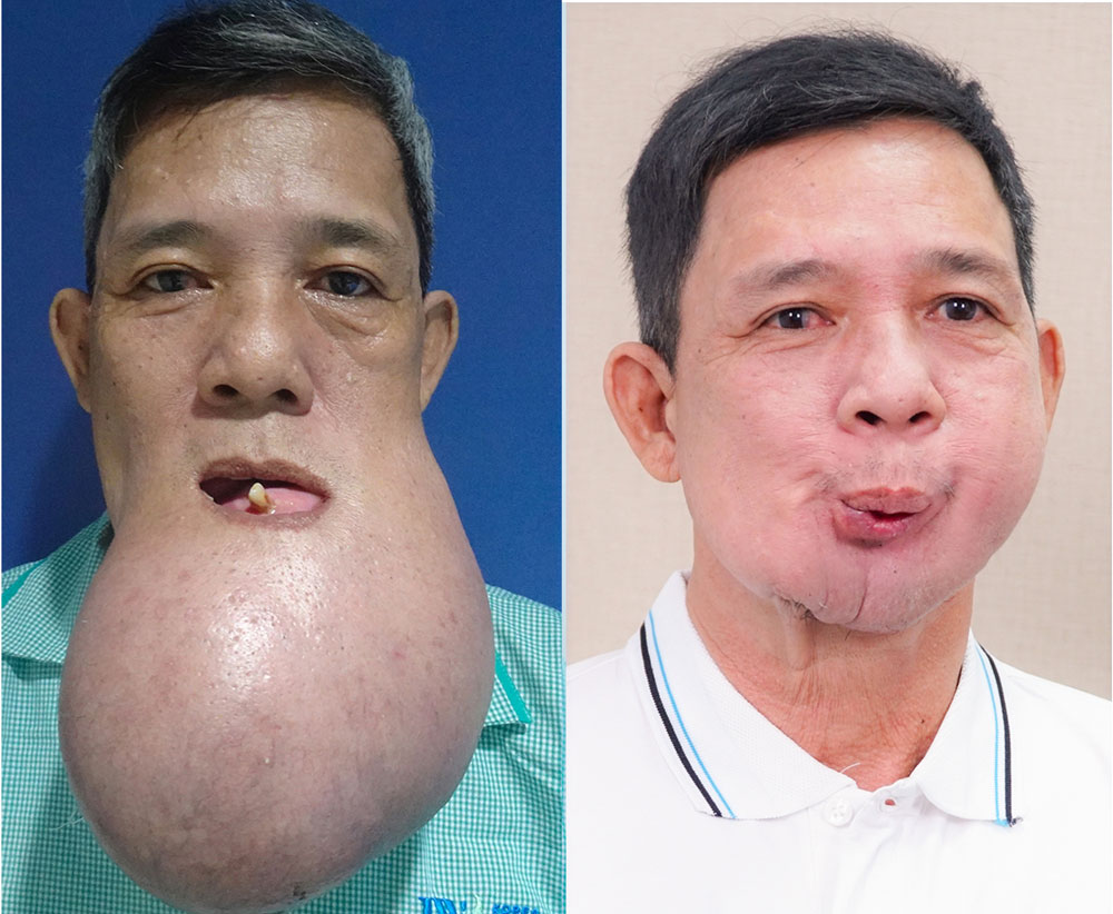 Ông Lê Quang Khanh sau phẫu thuật