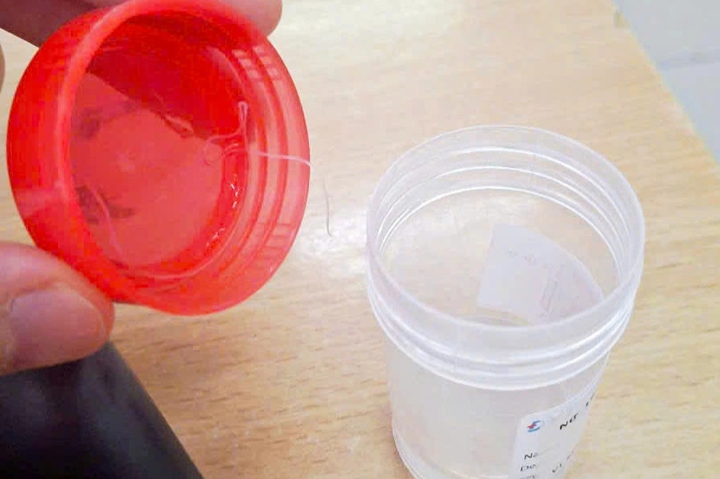 Sinh vật lạ dài gần 10 cm trong mắt người phụ nữ- Ảnh 1.