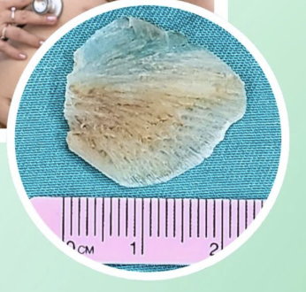 Cứu sống kịp thời bé gái bị bỏng thực quản do uống nhầm hóa chất - Ảnh 2.