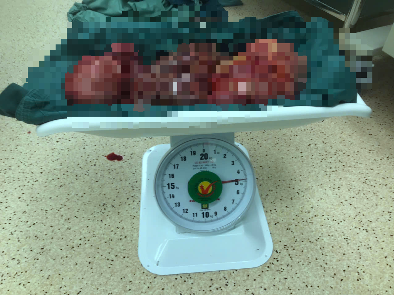 Khối u nặng 5 kg được tách ra khỏi cơ thể người phụ nữ