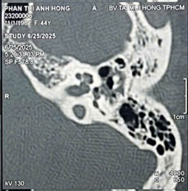 Chấn thương tai do ngoáy tai - Ảnh 2.